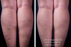 Les varices sont des veines qui se sont dilatées et qui sont de couleur bleuâtre.Les varices se développent le plus souvent au niveau des jambes.