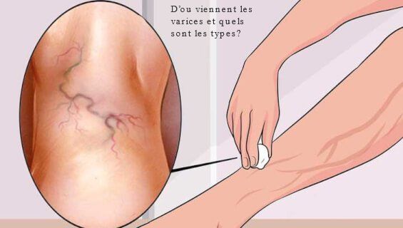D’ou viennent les varices et quels sont les types?