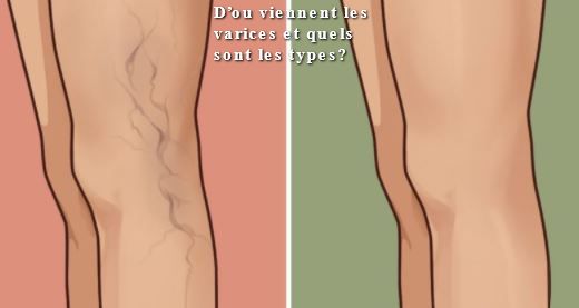 D’ou viennent les varices et quels sont les types?