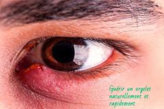 Infections bactériennes, bénignes, les orgelets sous l’œil peuvent être gênants surtout lorsqu'on a un rendez-vous dans les jours qui viennent.