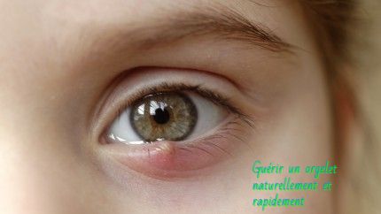Guérir un orgelet Guérir un orgelet naturellement et rapidement