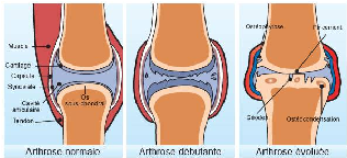 L'arthrose la maladie la plus fréquente
