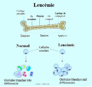 La leucémie;ses premiers signes et les traitements disponibles