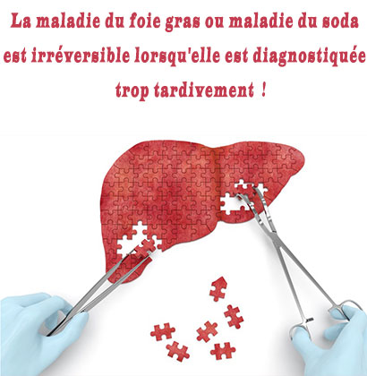 La maladie du foie gras ou maladie du soda est irréversible lorsqu'elle est diagnostiquée trop tardivement ! La maladie du foie gras ou maladie du soda est irréversible lorsqu'elle est diagnostiquée trop tardivement !