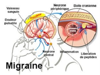 la migraine quelle est la cause et le traitement possible?