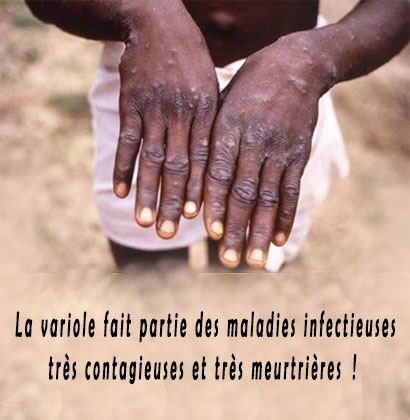 La variole fait partie des maladies infectieuses très contagieuses et très meurtrières !