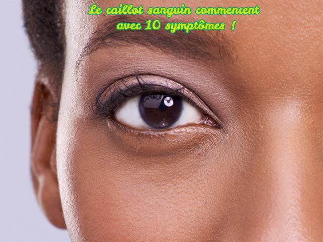 La caillot sanguin Le caillot sanguin commencent avec 10 symptômes !