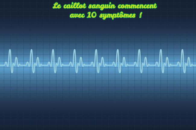 Le caillot sanguin Le caillot sanguin commencent avec 10 symptômes !
