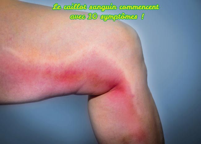 Le Caillot sanguin Le caillot sanguin commencent avec 10 symptômes !