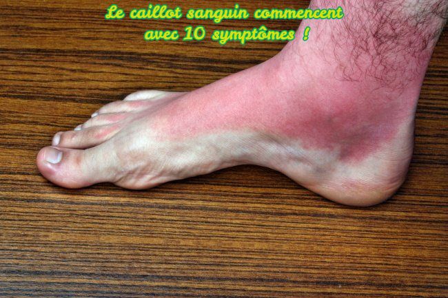 La caillot sanguin Le caillot sanguin commencent avec 10 symptômes !