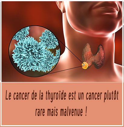 Le cancer de la thyroïde est un cancer plutôt rare mais malvenue !