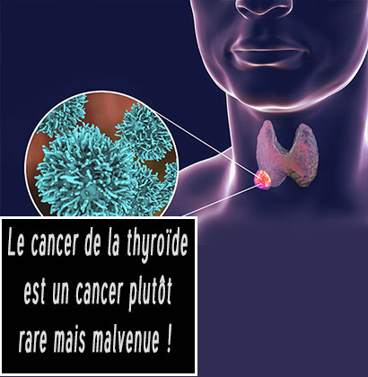 Le cancer de la thyroïde est un cancer plutôt rare mais malvenue !