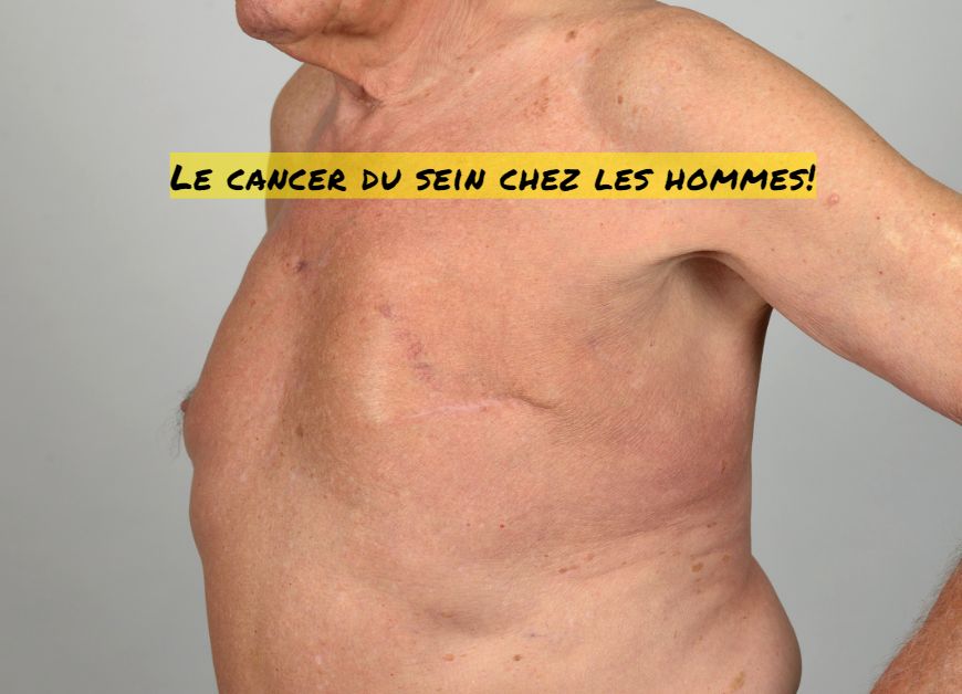 Le Cancer du sein chez les hommes Le cancer du sein chez les hommes!