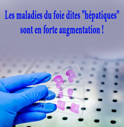 Les maladies du foie dites Les maladies du foie dites "hépatiques" sont en forte augmentation !