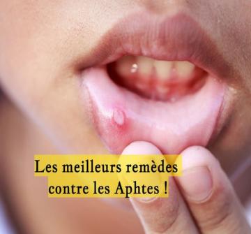 Les aphtes sont de petits ulcères douloureux de la sphère buccale. Pour s’en débarrasser, des remèdes naturels existent.