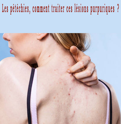 Les pétéchies, comment traiter ces lésions purpuriques ? Les pétéchies, comment traiter ces lésions purpuriques ?