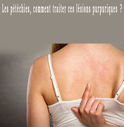 Les pétéchies, comment traiter ces lésions purpuriques ? Les pétéchies, comment traiter ces lésions purpuriques ?