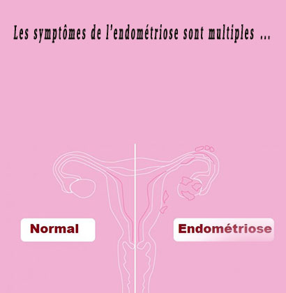 Les symptômes de l’endométriose sont multiples ... 