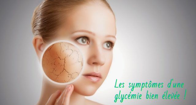 Une peau sèche Les symptômes d'une glycémie bien élevée !