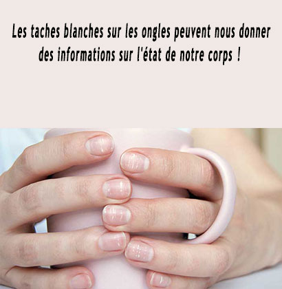 Les taches blanches sur les ongles peuvent nous donner des informations sur l'état de notre corps !
