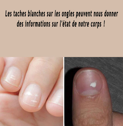 Les taches blanches sur les ongles peuvent nous donner des informations sur l'état de notre corps !