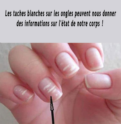 Les taches blanches sur les ongles peuvent nous donner des informations sur l'état de notre corps !