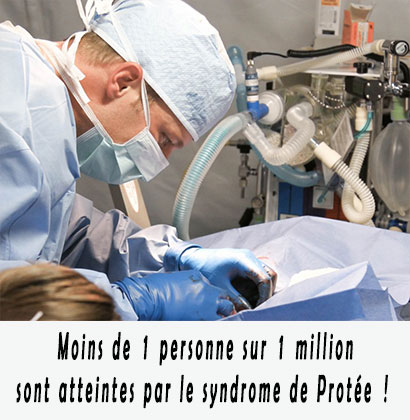 Moins de 1 personne sur 1 million sont atteintes par le syndrome de Protée !
