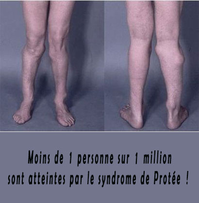 Moins de 1 personne sur 1 million sont atteintes par le syndrome de Protée !