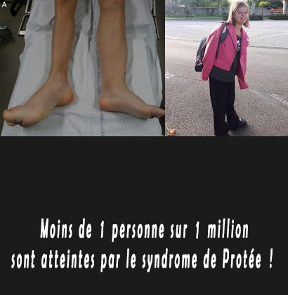 Moins de 1 personne sur 1 million sont atteintes par le syndrome de Protée !