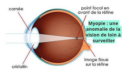 Myopie : une anomalie de la vision de loin à surveiller