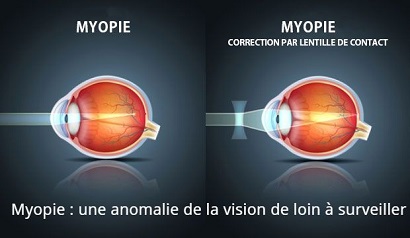 Myopie : une anomalie de la vision de loin à surveiller