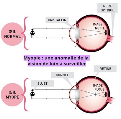 Myopie : une anomalie de la vision de loin à surveiller