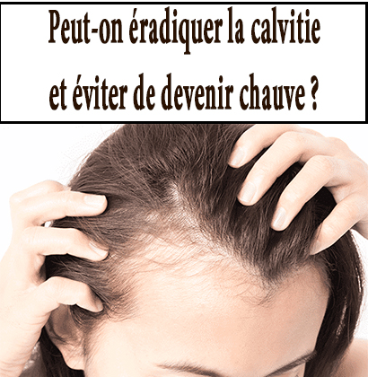 Peut-on éradiquer la calvitie et éviter de devenir chauve ?