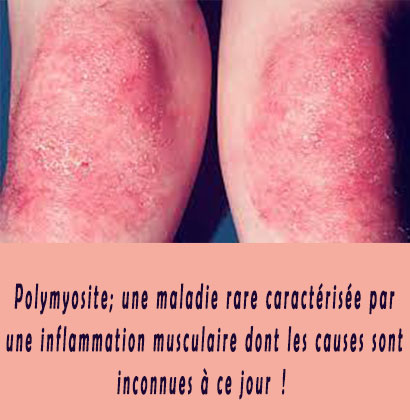 Polymyosite; une maladie rare caractérisée par une inflammation musculaire dont les causes sont inconnues à ce jour ! Polymyosite; une maladie rare caractérisée par une inflammation musculaire dont les causes sont inconnues à ce jour !