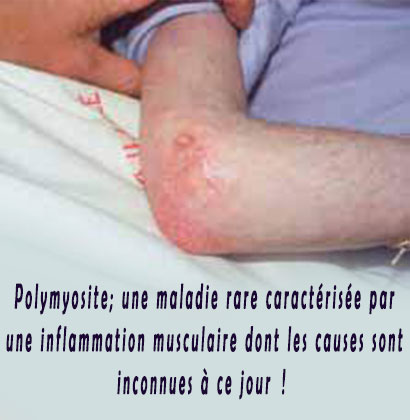 Polymyosite; une maladie rare caractérisée par une inflammation musculaire dont les causes sont inconnues à ce jour ! Polymyosite; une maladie rare caractérisée par une inflammation musculaire dont les causes sont inconnues à ce jour !