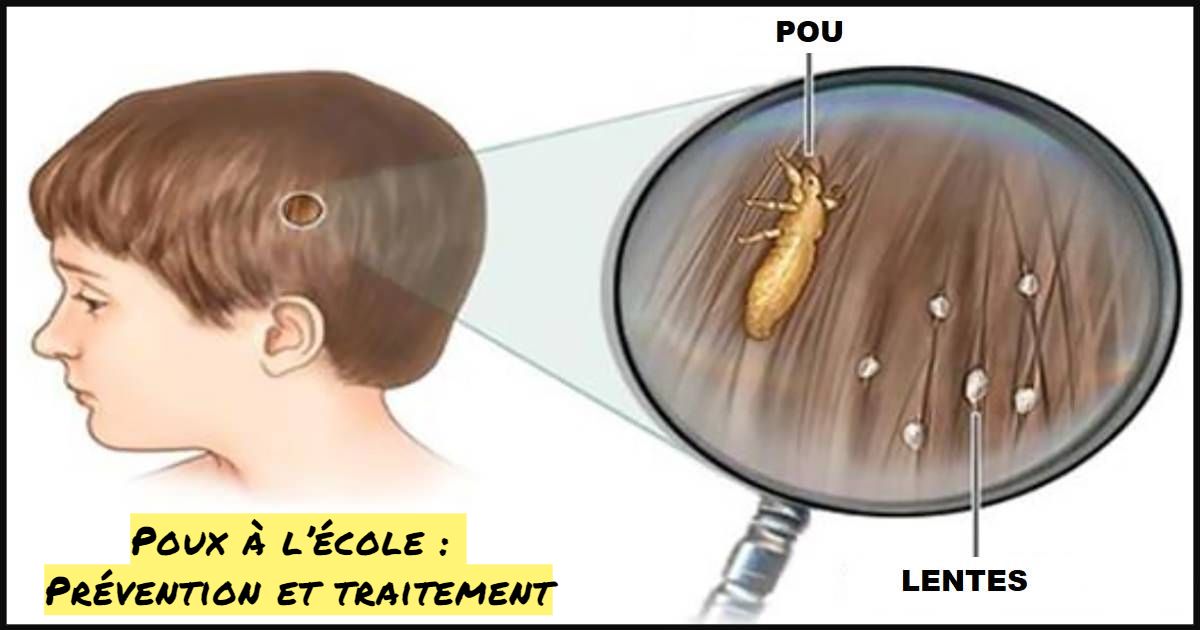 Poux à l’école : Prévention et traitement