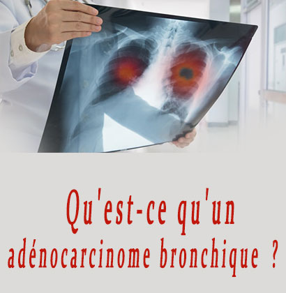 Qu'est-ce qu'un adénocarcinome bronchique ? Qu'est-ce qu'un adénocarcinome bronchique ?