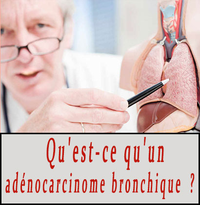 Qu'est-ce qu'un adénocarcinome bronchique ?