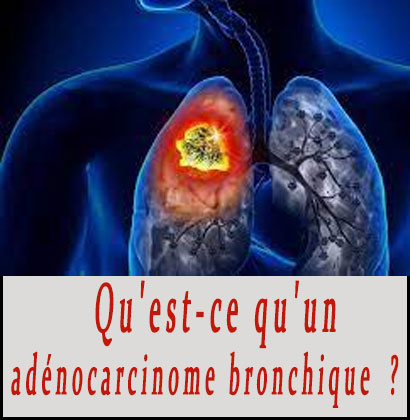 Qu'est-ce qu'un adénocarcinome bronchique ? Qu'est-ce qu'un adénocarcinome bronchique ?