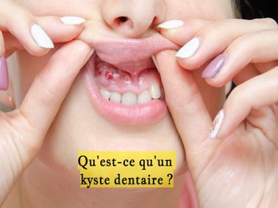 Qu'est-ce qu'un kyste dentaire ?