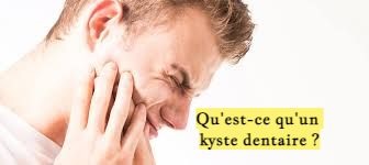 Qu'est-ce qu'un kyste dentaire ?
