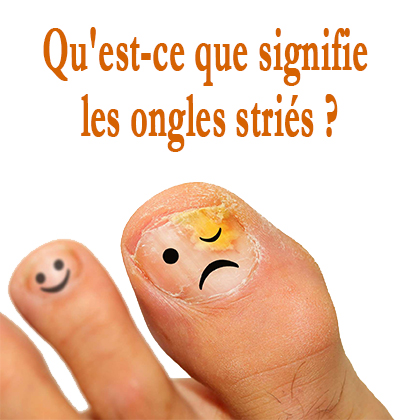 Qu'est-ce que signifie les ongles striés ?