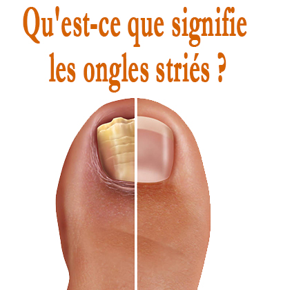 Qu'est-ce que signifie les ongles striés ?
