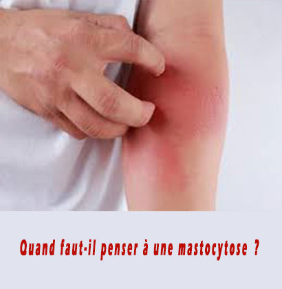 Quand faut-il penser à une mastocytose ?