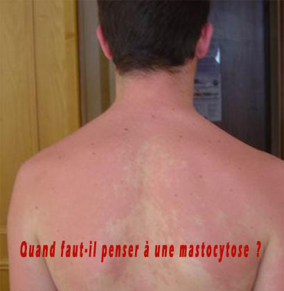 Quand faut-il penser à une mastocytose ?