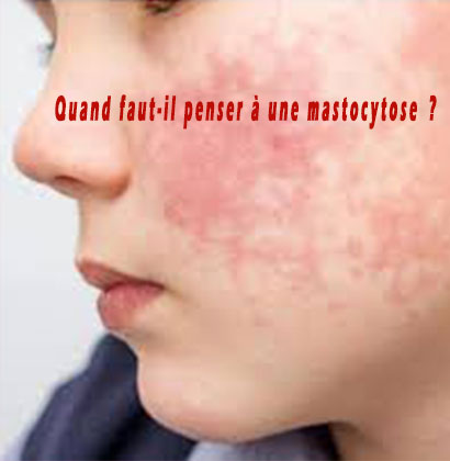 Quand faut-il penser à une mastocytose ?