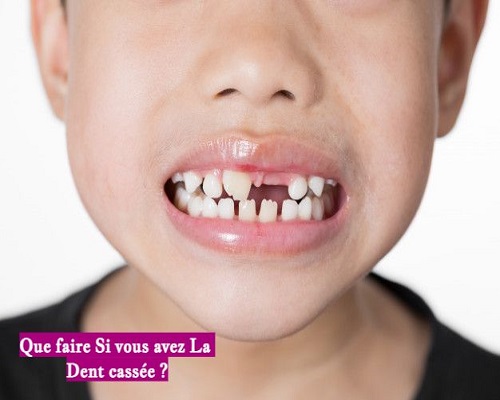 Que faire Si vous avez La Dent cassée ?