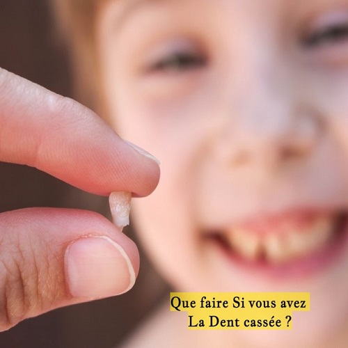 Que faire Si vous avez La Dent cassée ?