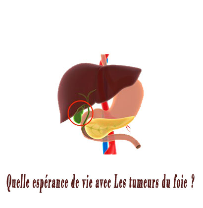 Quelle espérance de vie avec Les tumeurs du foie ? Quelle espérance de vie avec Les tumeurs du foie ?
