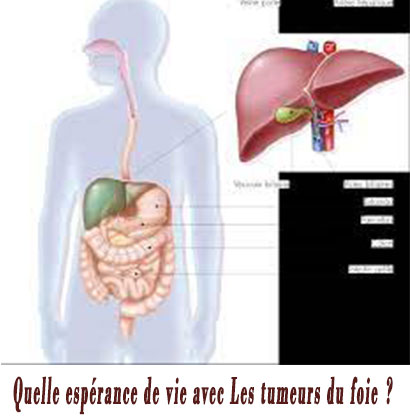 Quelle espérance de vie avec Les tumeurs du foie ? Quelle espérance de vie avec Les tumeurs du foie ?